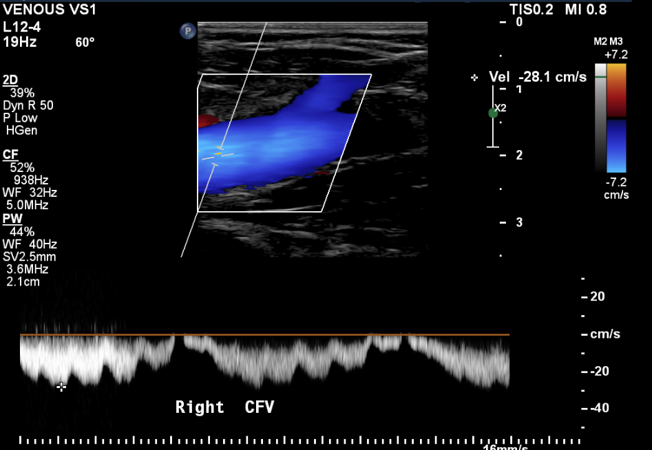 Is The Gold Standard Causing Misdiagnosis Varicose Vein Treatment