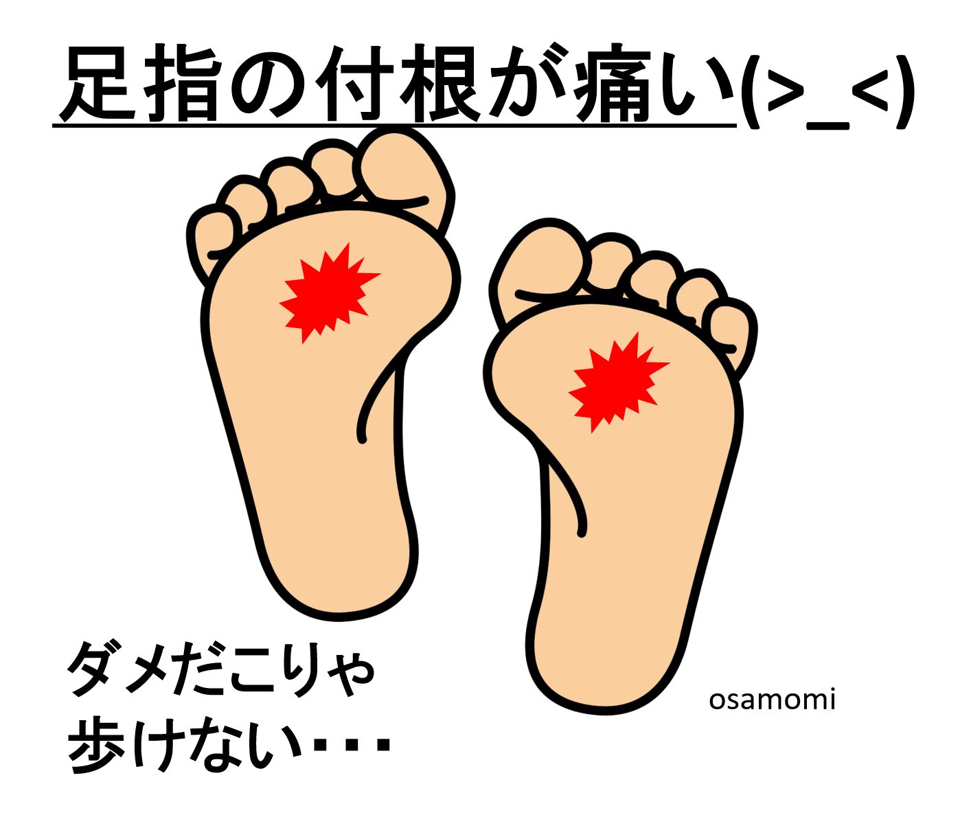 よく見ると足趾が曲がってる！足趾の屈曲変形の足は、中足骨頭部痛やタコが出来ます。昭島市のオサモミ整体院は、足ケアのプロフェッショナル