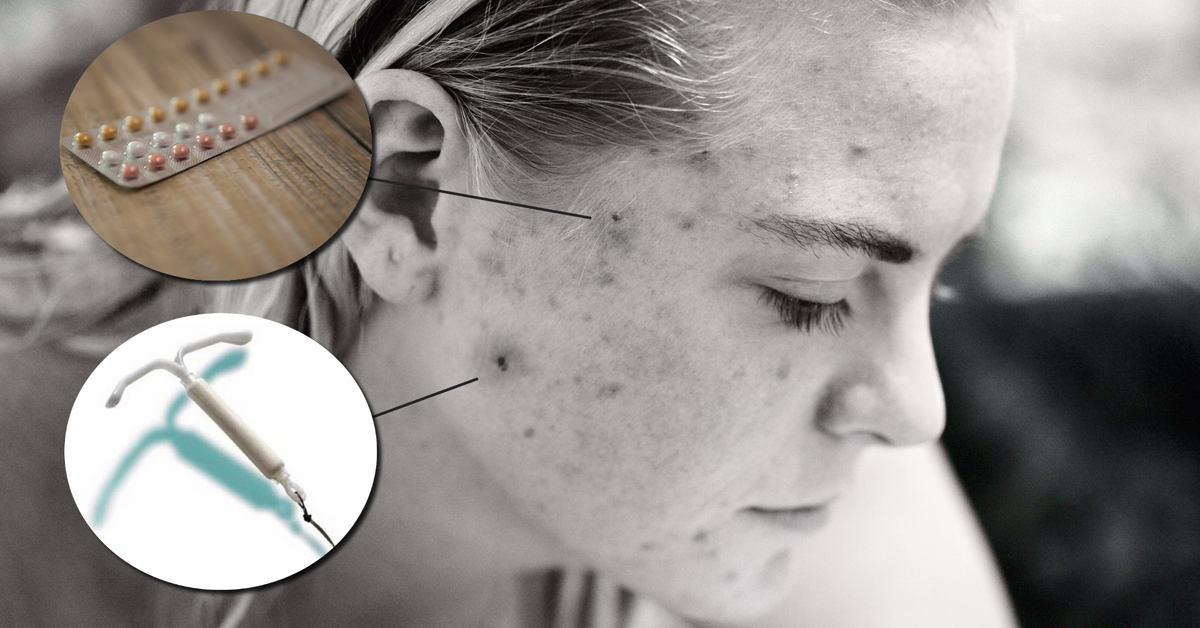 De Invloed Van Anti Conceptie Op De Huid Huidstudio Leek