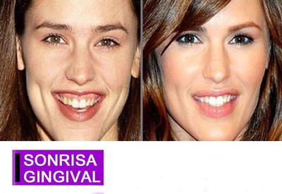 Antes y después de eliminación de la sonrisa gingival en la que se mostraba mucha porción de encías siendo considerado antiestético