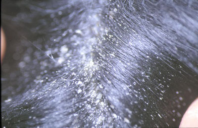Photo  : Cheyletiellose chez un chien