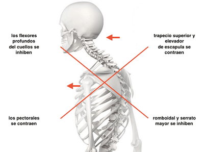 Síndrome cruzado anterior y dolor interescapular, dorsal o de omóplatos