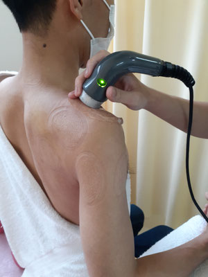 骨折部位は超音波をあて骨癒合を早めます