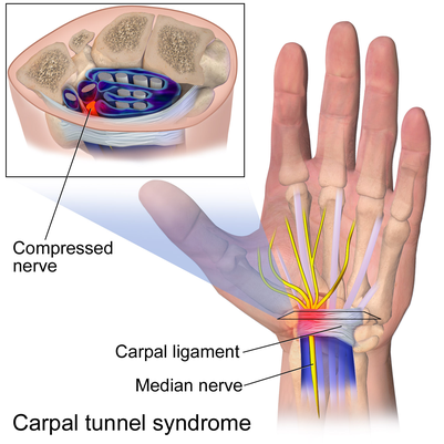 ＊Carpal tunnel syndrome=手根管症候群、Median nerve=正中神経