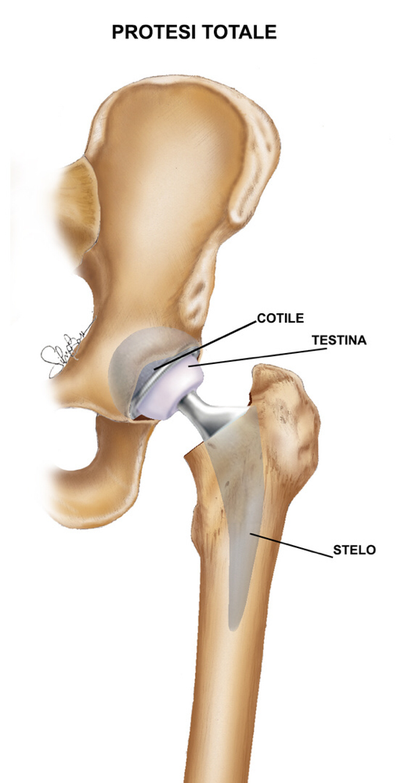 IMPIANTO DI ARTROPROTESI ANCA