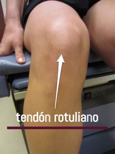 Fisioterapia tendinitis rotuliana