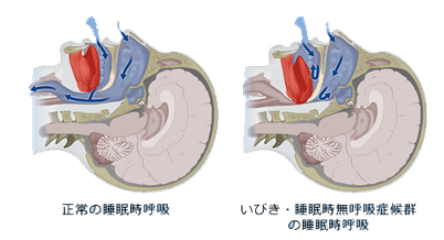 いびき　睡眠時無呼吸症候群　しまだ　耳鼻咽喉科　大阪府　堺市
