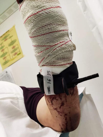 Torniquete comercial en caso real