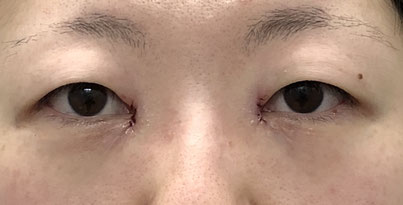 目頭切開術後の画像