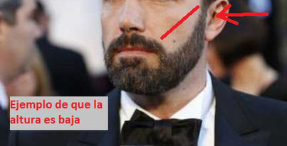 por que no sirve el minoxidil para barba