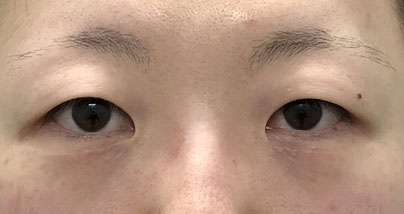 目頭切開症例の写真