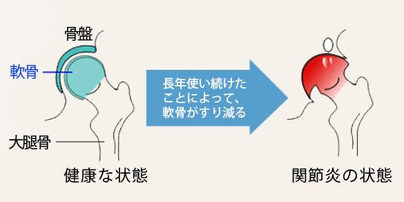 変形性関節症　整骨院　鍼　鍼灸院　整形外科　松戸