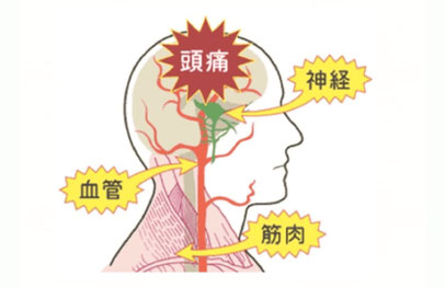 筋肉の張りやコリが神経や血管を圧迫して頭痛が発生します。