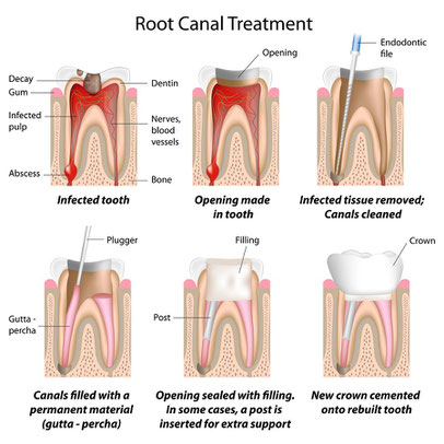Root Canal Spanish Fork