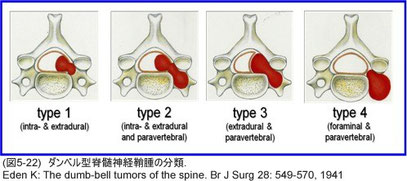 Eden classification for dumb-bell tumor