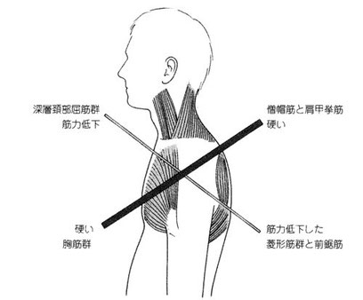 猫背の状態画像