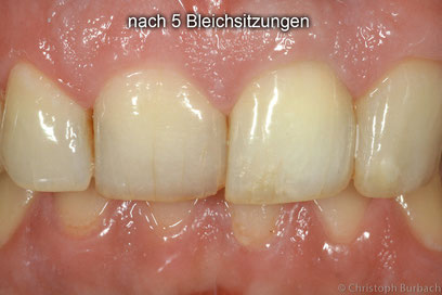 durch internes Bleaching aufgehellter Zahn