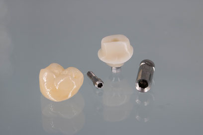 Implantat-Versorgung