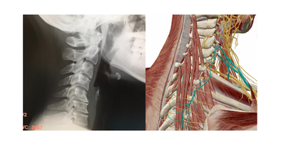 頸椎症　レントゲン　神経
