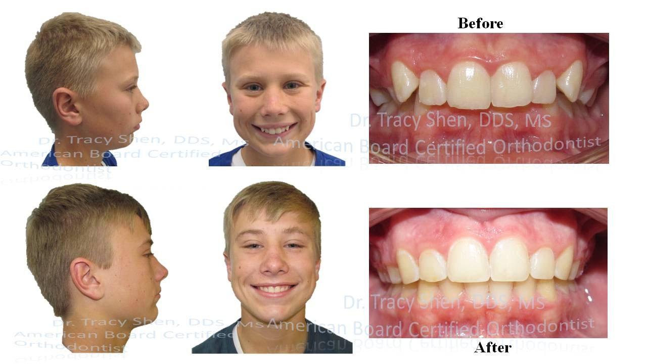 Before and After orthodontic treatment Suncreek Orthodontics in Allen
