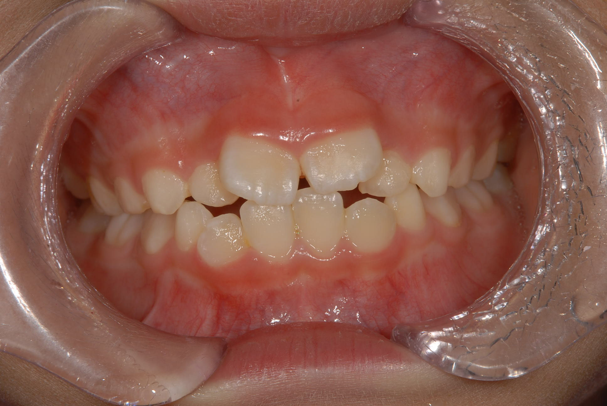 非抜歯矯正 - ふなつデンタルクリニックのHP