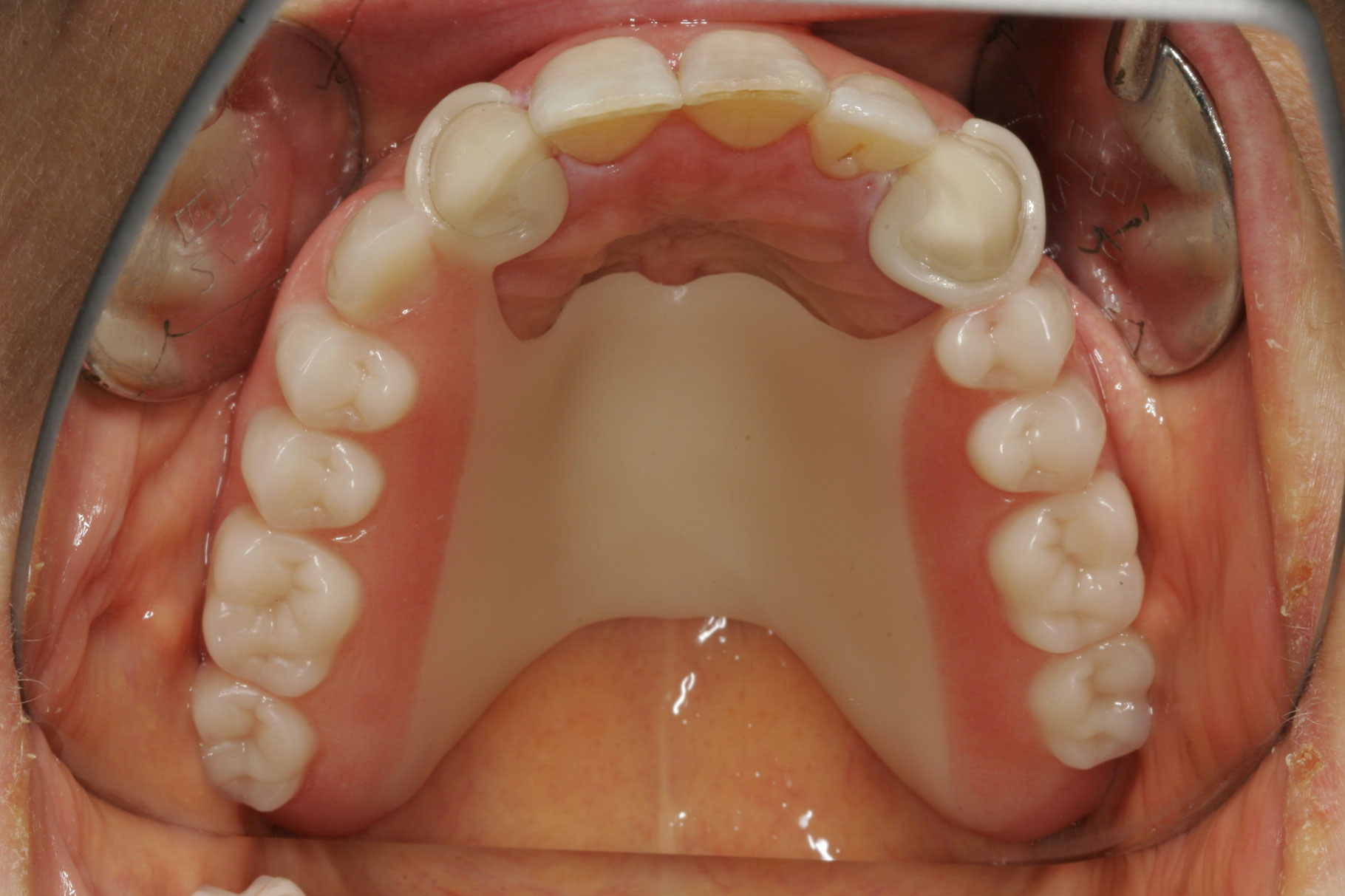 Der Weisse Modellguss Premium Sensitive Metallfreier Zahnersatz