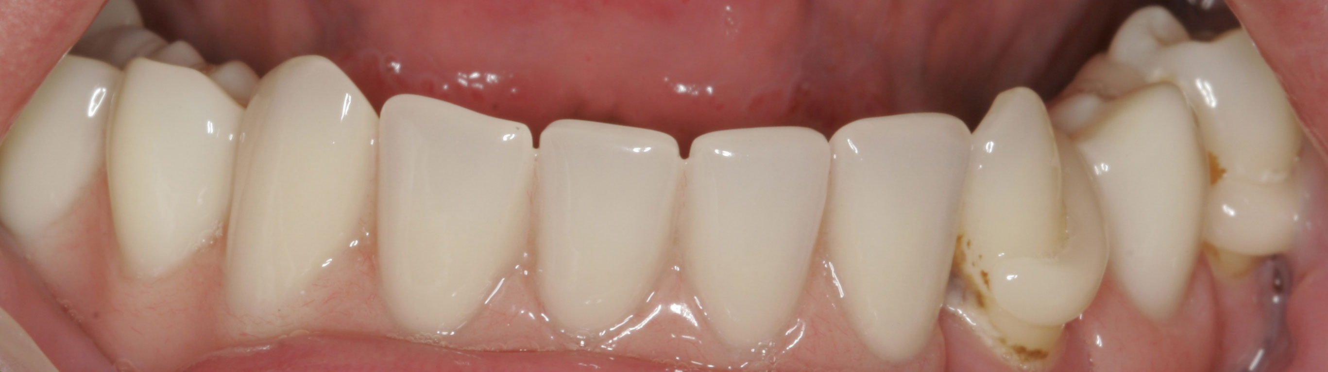 Zahnfarbene Klammern Premium Sensitive Metallfreier Zahnersatz