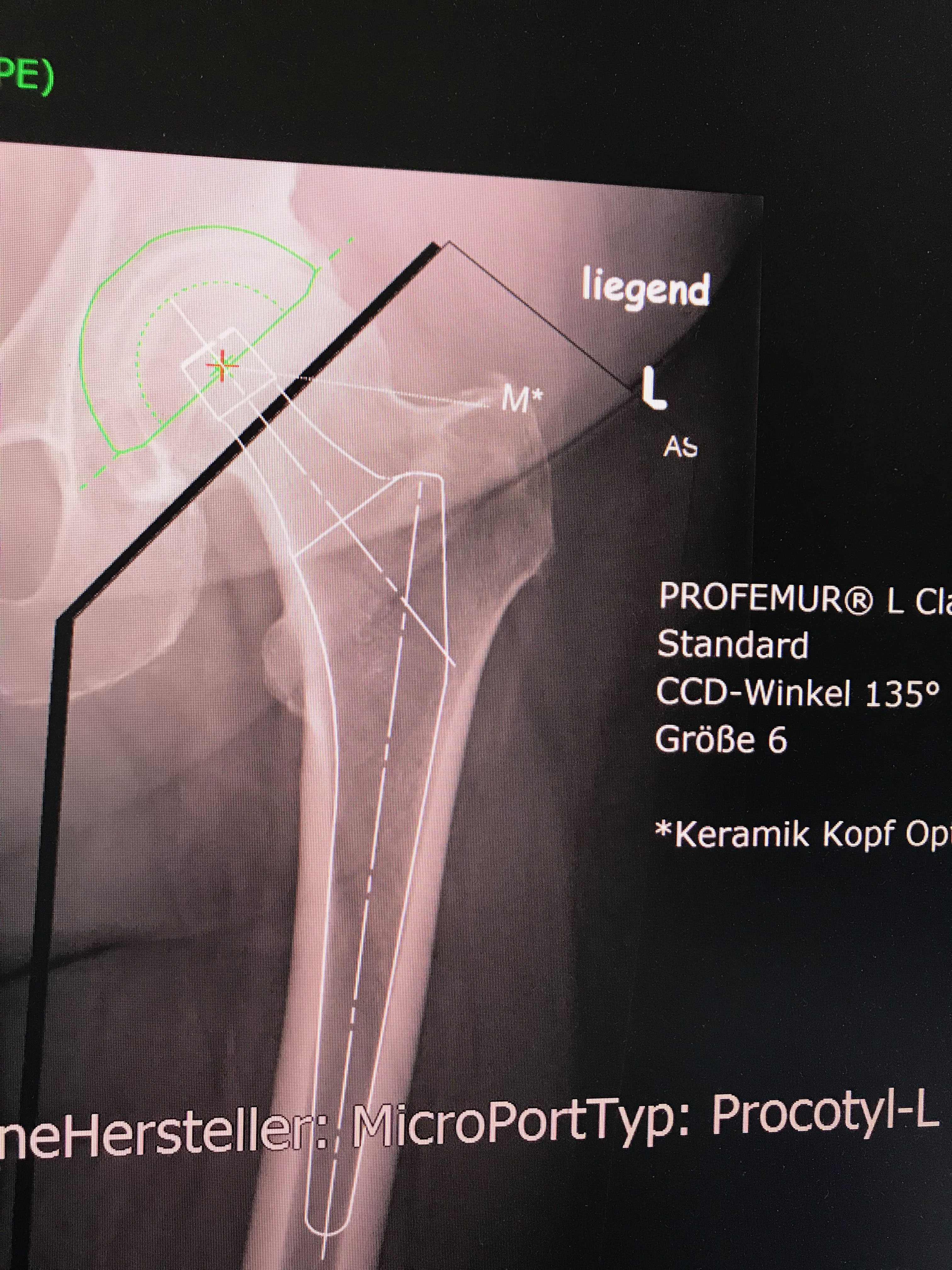 Kunstlicher Gelenkersatz Endoprothesenzentrum Dr Dirk Hedrich Orthopadie Und Rheumatologie Endoprothesenzentrum