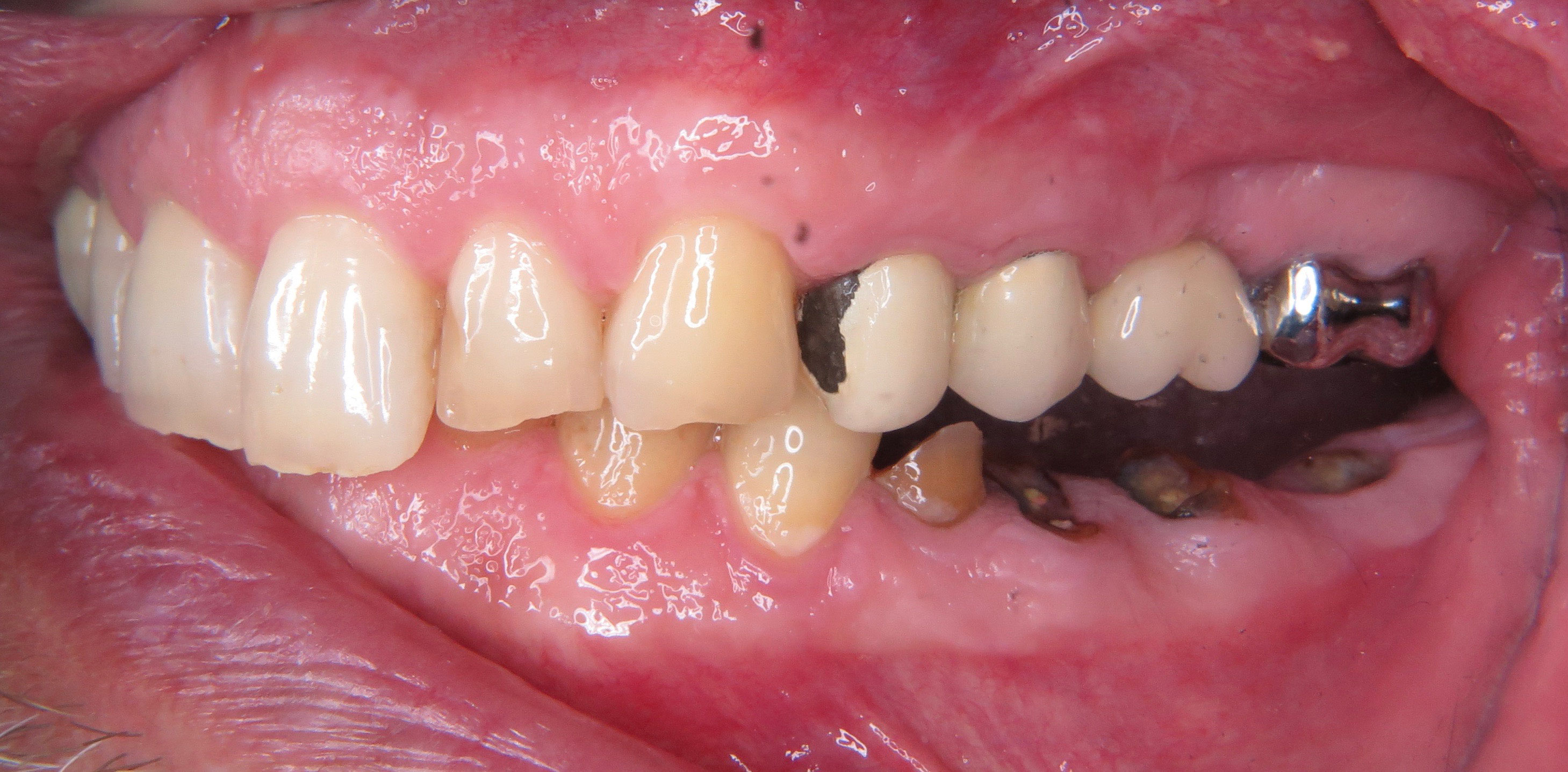 Zerstörte Zähne und Zahnabrasionen - der Implantatexperte
