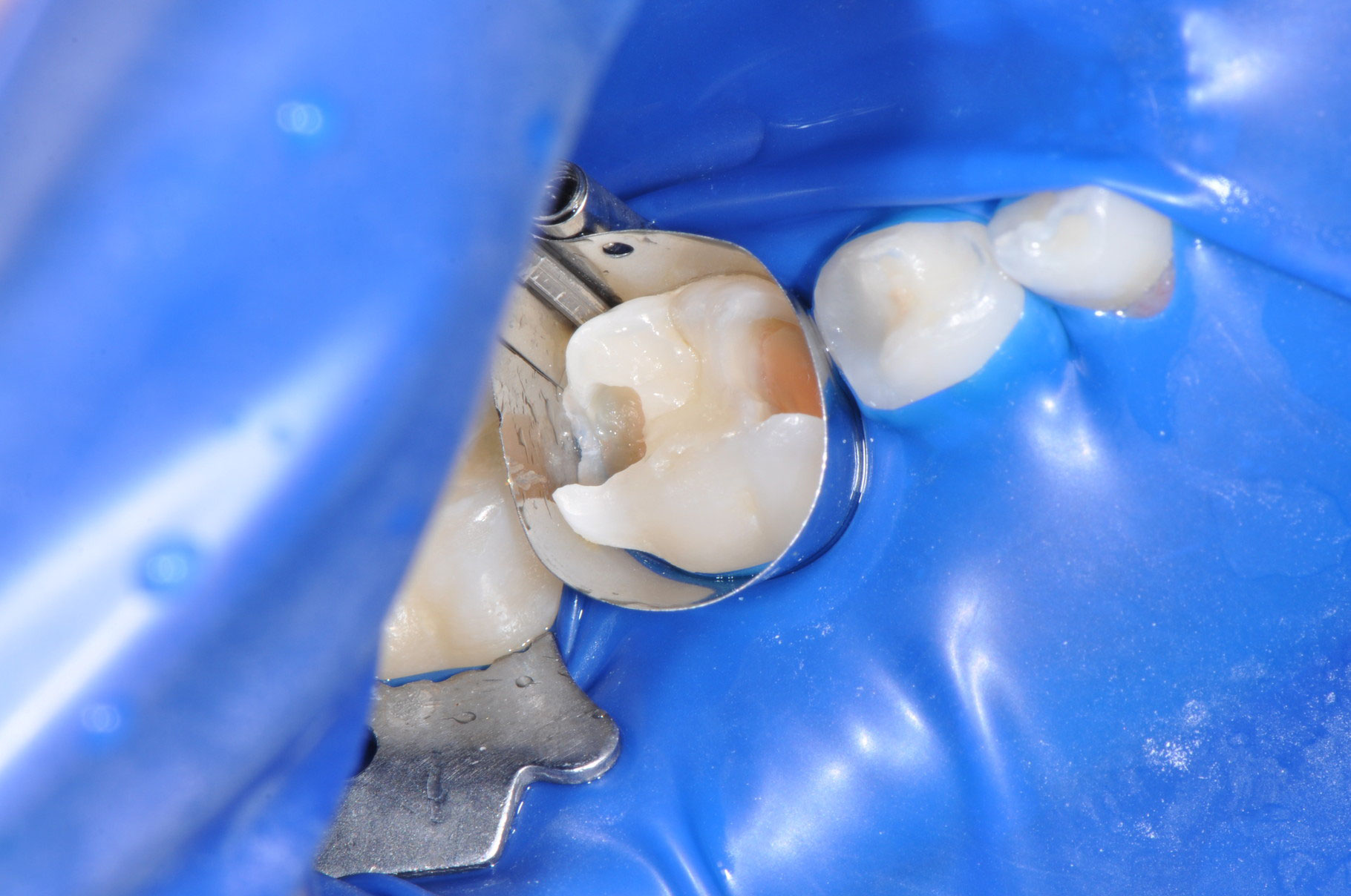 Come Togliere Un Dente Da Latte Carie dente da latte - Dentista Aprilia Dr.Luca Zoboli Odontoiatria