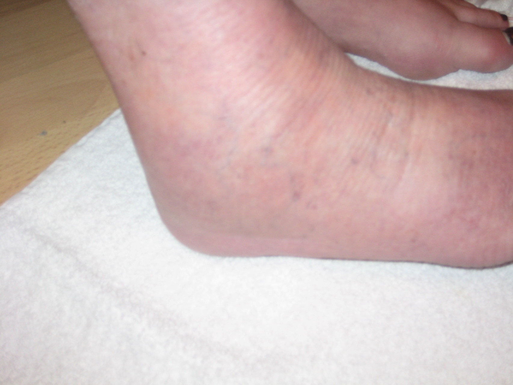 2) Fall Morbus Sudeck Schulungspraxis Seybold