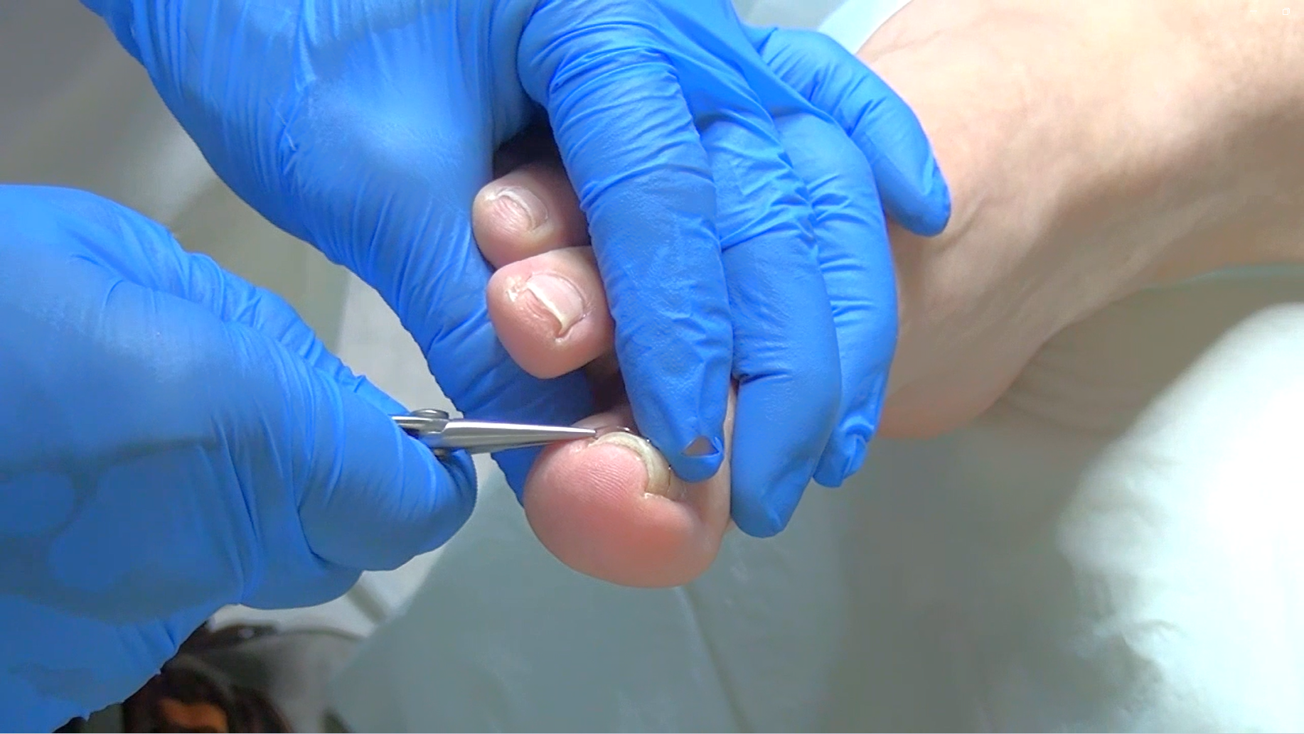 ＫＫＫ。巻き爪補正ベーシックコース　日本フットケア普及協会 KKK。巻き爪補正ベーシックコース 日本フットケア普及協会 ペディ