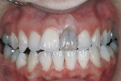 Zahn grau verfärbt