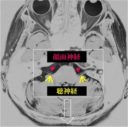 頭部MRI画像で確認できる顔面神経とその位置 画像