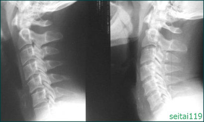 ストレートネック,頚椎の湾曲