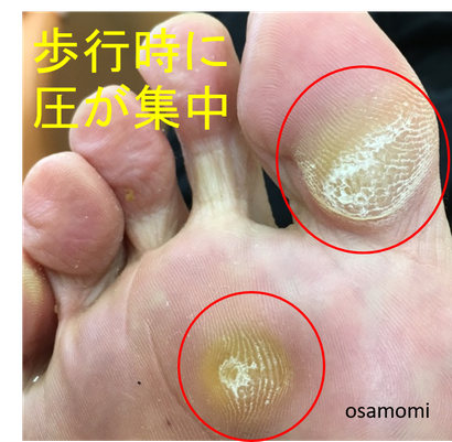 タコ 魚の目の悩み 外反母趾 膝痛 タコ魚の目専門 競歩技術を
