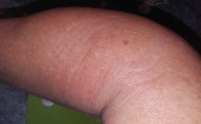 Schwellung nach Biss durch Skolopender-4 Tage nach dem Biss