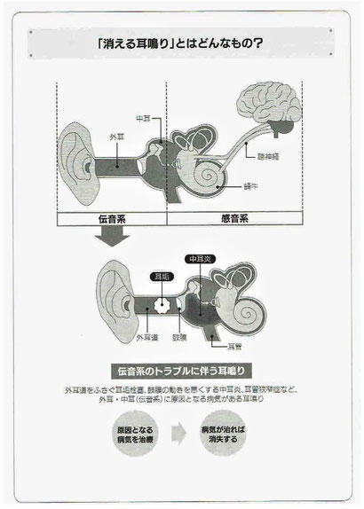 消える耳鳴りとはどんなもの？