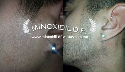 minoxidil para barba resultados antes despues