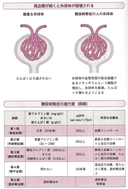 高血糖が続くと糸球体が破壊される