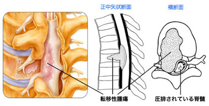 脊椎腫瘍絵図