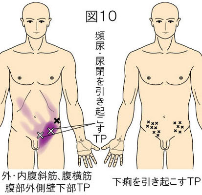 腹筋のトリガーポイントによる頻尿・尿閉・下痢・腹痛