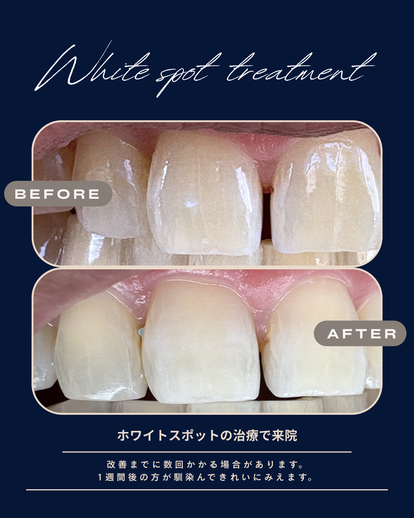 ホワイティデンタルクリニックのホワイトスポット治療の症例写真　