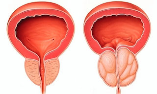 adenoma prostate prostata bilobata