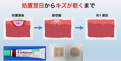 施術翌日からキズが乾くまでの経過イメージ