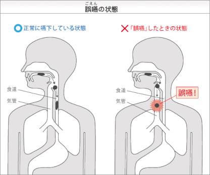 八戸市の歯医者　くぼた歯科医院　誤嚥　肺炎　歯科　訪問歯科