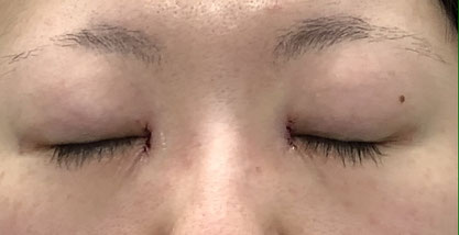 目頭切開術後の画像