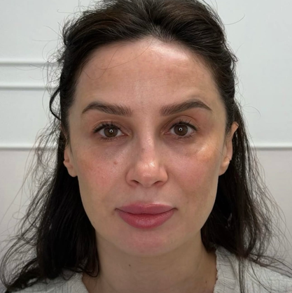 Lippen aufspritzen München, Julia Horn, Lippen spritzen