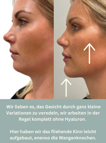 Wangenknochen Kinn Jawline Radiesse