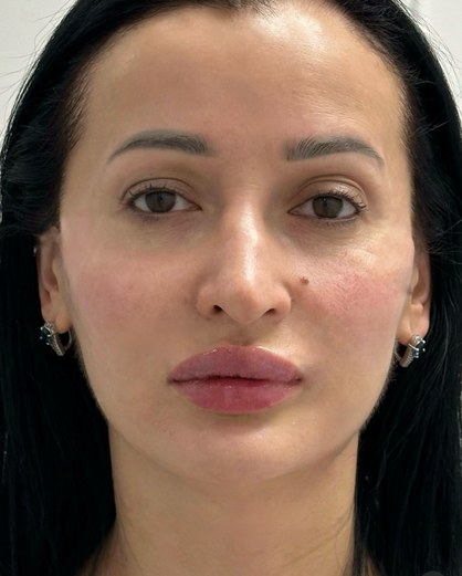 Nach Lippenauffüllung und Radiesse Wangenknochen und Kinn und Jawline und Tränenrinne auffüllen